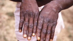 Monkeypox: 11 persons placed under surveillance in Bayelsa