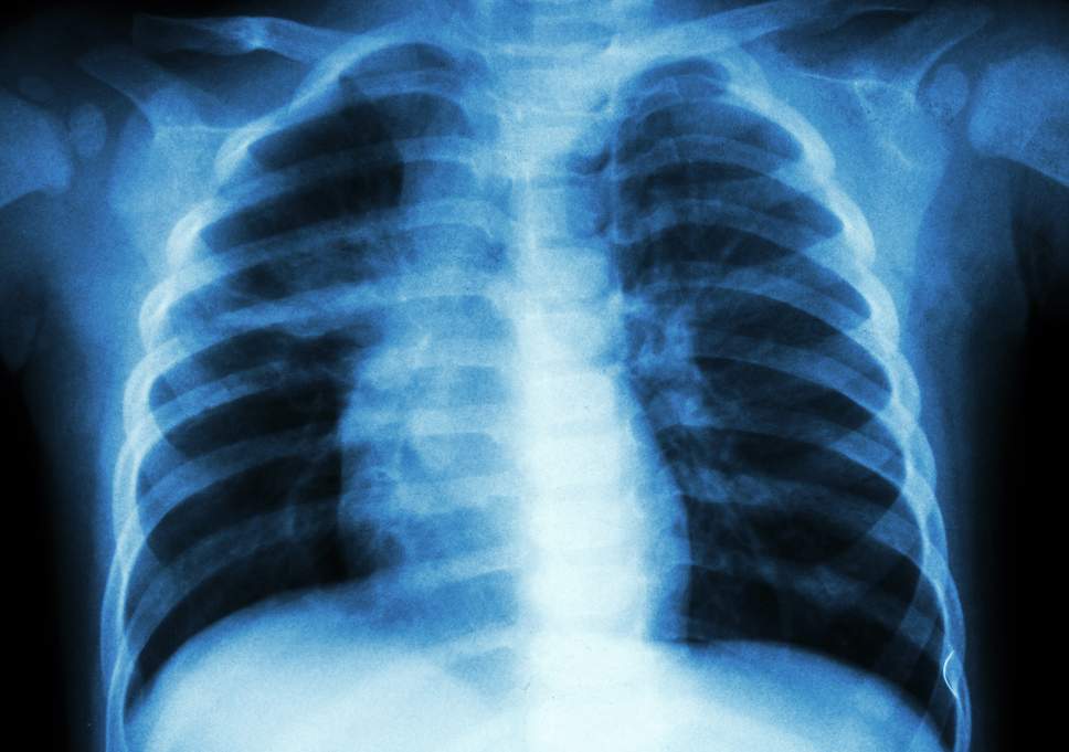 Tuberculosis: Doctors explain disease, proffer solutions