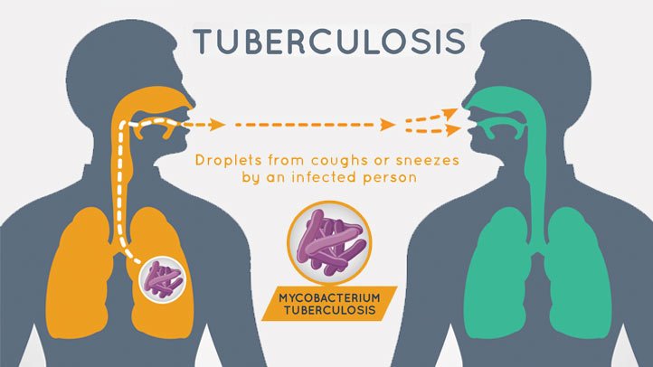 Nigeria ranks first in Africa on Tuberculosis infection – WHO