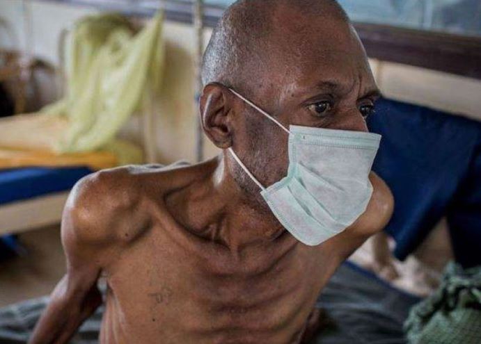 World Tuberculosis Day: Nigeria has highest TB infection cases in Africa — WHO