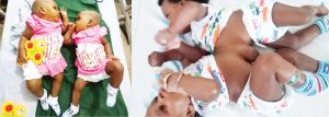 FMC Yola celebrates third successful conjoined twins separation