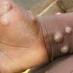 Four Monkeypox cases confirmed in Ogun State