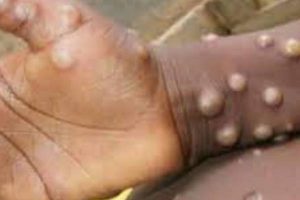 Four Monkeypox cases confirmed in Ogun State