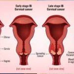 WOMEN, GIRLS URGED TO GO FOR CERVICAL CANCER SCREENING