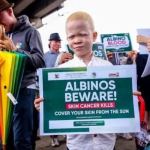 Cancer Prevention Measures for People Living with Albinism