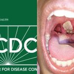 NCDC begins sample collection over diphtheria outbreak in Abuja